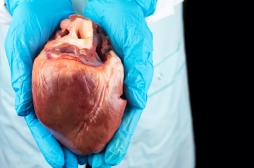 Les patients atteints d'hépatite C élargissent le bassin de donneurs de cœur