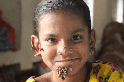 Une fillette atteinte de la même maladie que 