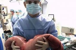 Chine : les médecins lui retirent 13 kg de matières fécales du ventre