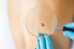 Mélanome : un marqueur sanguin permet d’optimiser le traitement 