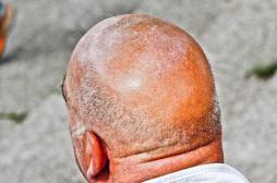 Propolis : la nouvelle piste des chercheurs contre la calvitie 