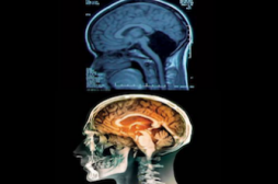 A 24 ans une Chinoise apprend qu'elle n'a pas de cervelet 