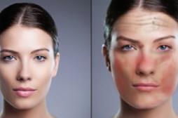 Alcool: une campagne pour montrer les ravages physiques