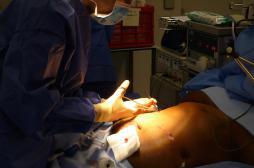 La chirurgie de l'obésité traite le diabète avant le poids