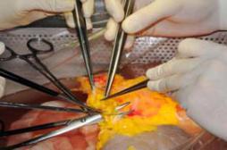 Coup d'accélérateur pour les donneurs vivants