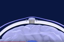 Tumeurs cérébrales : les ultrasons pourraient améliorer les traitements