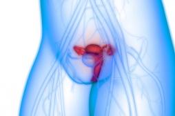 Cancer de l'ovaire BRCA-muté : intérêt d’un inhibiteur de PARP sur la survie sans progression