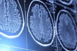 Cancer du cerveau : les femmes et les hommes ne devraient pas être traités pareil