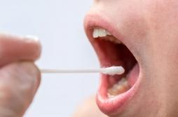 Cancer de la cavité buccale : un test salivaire pour faciliter le diagnostic 