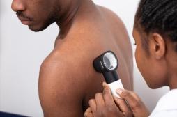 Cancer de la peau : une IA capable de détecter les mélanomes, même sur les peaux foncées
