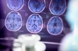 Alzheimer : une nouvelle découverte sur la structure du cerveau ouvre des pistes de traitement