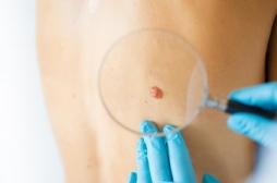 Cancer de la peau : prédire l’agressivité des tumeurs en analysant les tissus autour des cellules