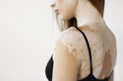 La chanteuse Pomme atteinte du vitiligo : qu'est-ce que cette maladie ?
