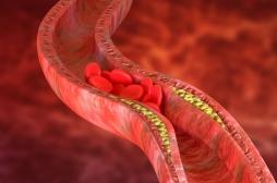 Maladie coronarienne à 30 ans : une cause génétique identifiée
