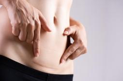 Césarienne : ses effets sur le microbiote diffèrent en fonction du sexe 