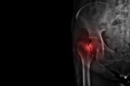 Ostéoporose : une fracture de la hanche chez l'un des parents augmente le risque