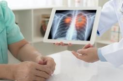 Cancer du poumon : l’intérêt du dépistage pour réduire la mortalité