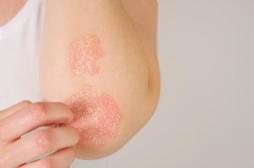 Comment le psoriasis peut devenir une maladie articulaire