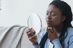 Acné chez les adolescents : les filles et les minorités ethniques davantage exposées à la détresse psychologique