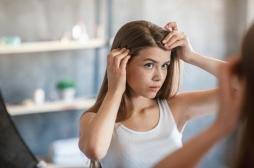 Hépatites aiguës menaçant le pronostic vital : alerte sur des vitamines pour les cheveux