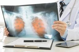 Cancer du poumon : ce signe repéré par Florent Pagny au début de la maladie