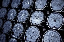 Alzheimer : la stimulation des neurones pourrait aider à soigner la maladie 