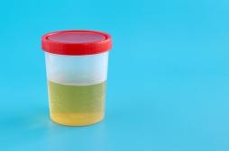 Cancer de la vessie : ce simple test pourrait évaluer le risque de récidive 