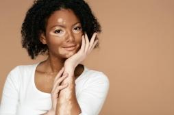 Vitiligo : plus de risque de dépression chez les patients ?