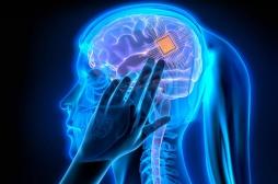 Un implant cérébral personnalisé pour traiter la dépression