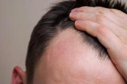 Calvitie : une nouvelle solution pour empêcher la chute des cheveux ? 