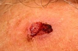 Cancer de la peau : découverte d'un marqueur qui prédit les métastases