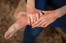 Psoriasis : les mutations spontanées dans les cellules de la peau ne sont pas en cause 