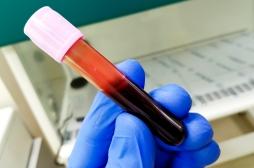 Cancer de l'ovaire : un test sanguin pourrait aider à le détecter plus tôt  