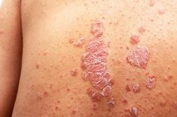 Psoriasis : 70 % des patients ont déjà souffert ou sont atteints d’au moins une maladie associée