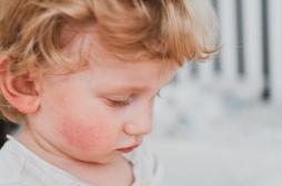 Parvovirus B19 : quels sont les symptômes de l’infection ?