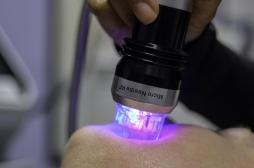 Chirurgie : le microneedling rendrait les cicatrices moins visibles 