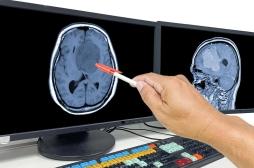 Cancer du cerveau : comment l’hyperactivité des neurones alimente la tumeur