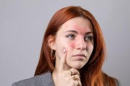 Dermatite atopique ou eczéma : un Français sur deux est complexé par sa peau