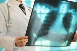 Embolie pulmonaire : 5 signes à prendre au sérieux 