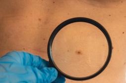 Cancer de la peau : comment le contrôle de l'inflammation liée à un coup de soleil peut le prévenir