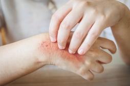 Eczéma : le traitement le plus répandu ne tiendrait pas ses promesses