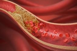 Cholestérol : ce traitement qui permettrait d’éviter les statines