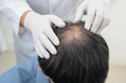 Analogues du GLP-1 : un effet inattendu sur les cheveux ?