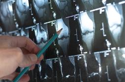 Ostéoporose : cet aliment consommé durant les fêtes aide à lutter contre cette maladie