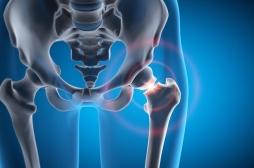 Fractures : les muscles cachent-ils un mécanisme protecteur ?