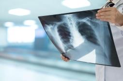 Pneumonie : ces trois facteurs aggravent vos risques 