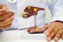 Alcoolisme chronique : pourquoi il empêche le foie de se régénérer