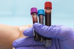 AVC : ce test sanguin aide à mieux gérer les conséquences et le traitement