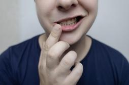 Son visage s'affaisse soudainement : qu’est-ce que la paralysie de Bell ?