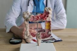 Ses symptômes cachaient un cancer colorectal de stade 4 